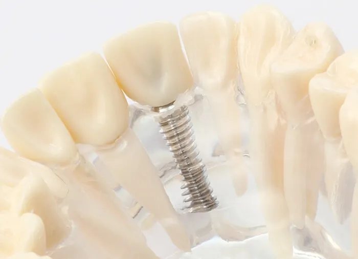 インプラント治療